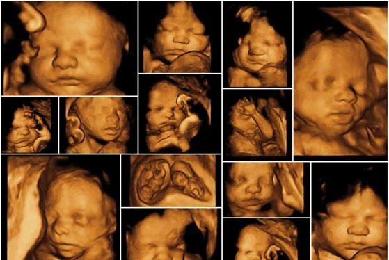 4D Ultrasound