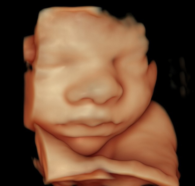 5d Ultrasound